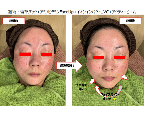 H様ビフォーアフター